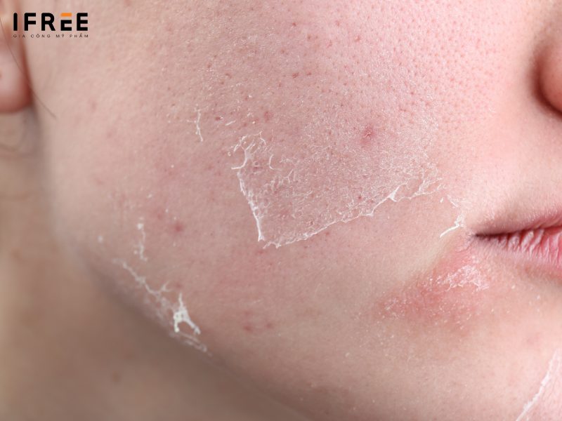 gia công sản phẩm peel da